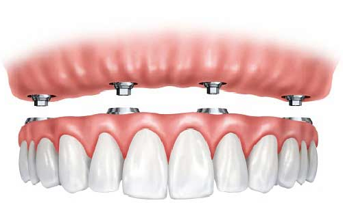 Implant supported denture